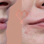 Ácido hialurónico labios, ¿cuánto dura? acido-hialuronico-labios-cuanto-dura