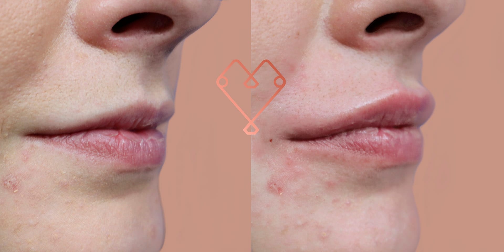 acido hialuronico labios cuanto dura