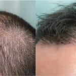 alopecia-por-estres-cuanto-dura
