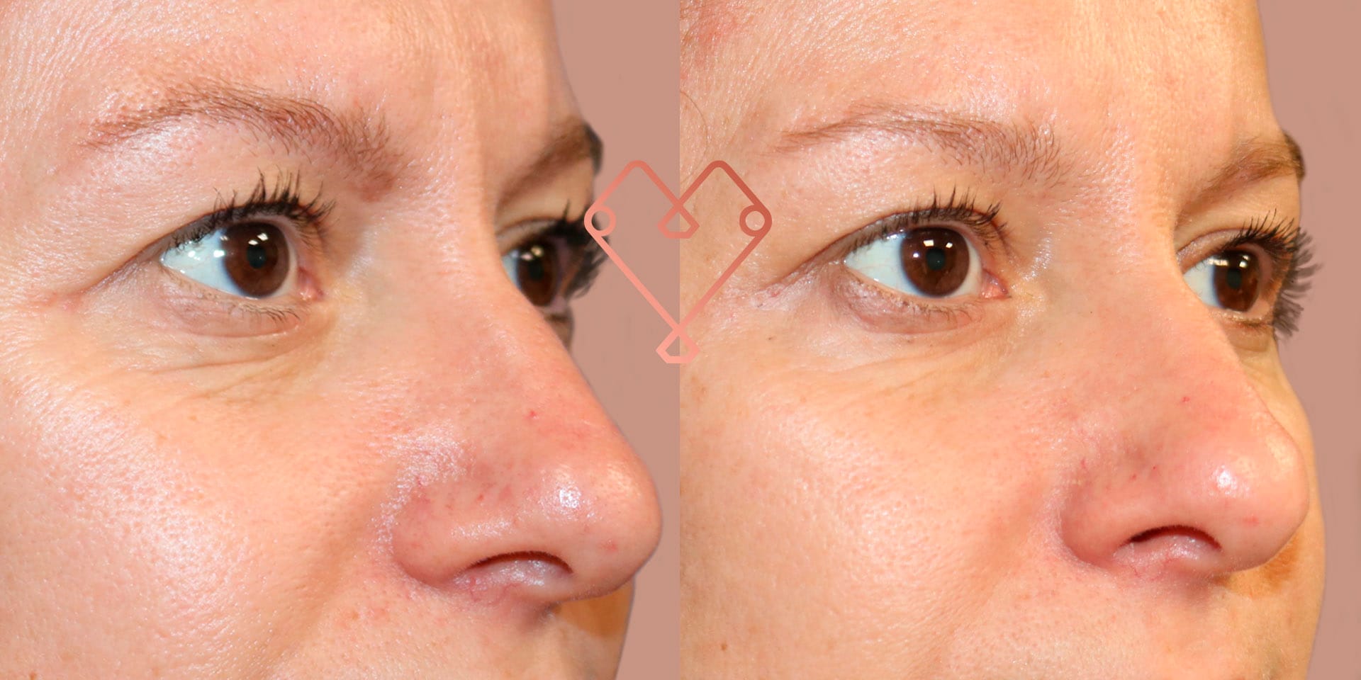 botox resultados en cuanto tiempo