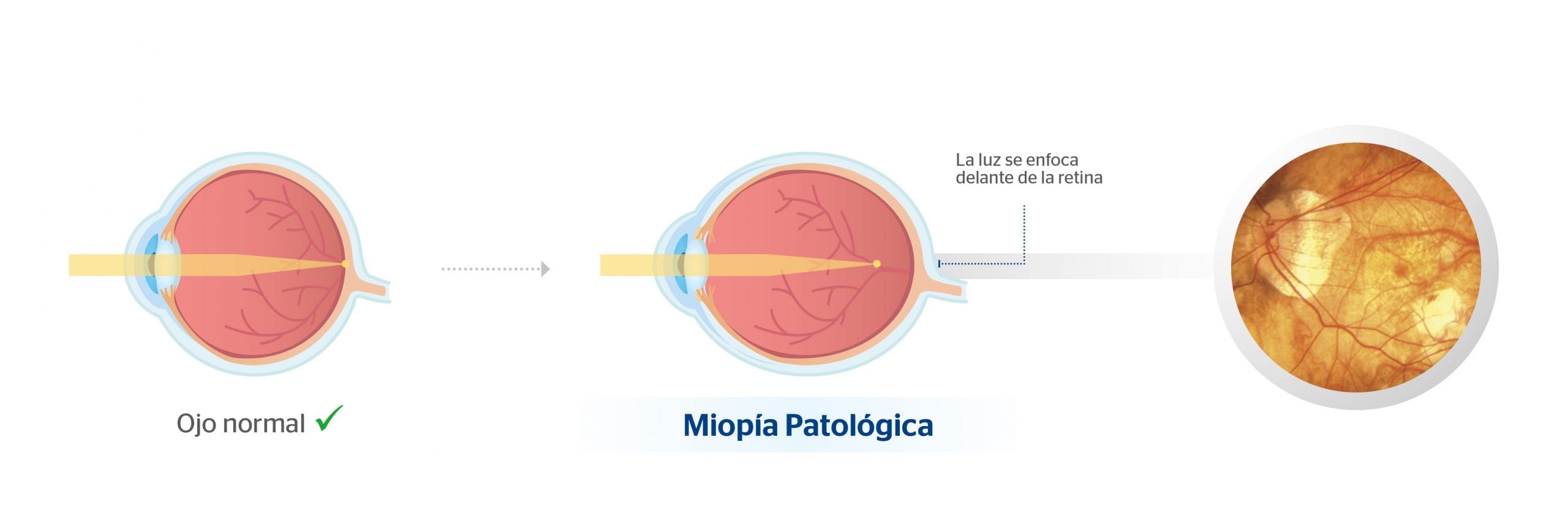como saber cuantas dioptrias tengo