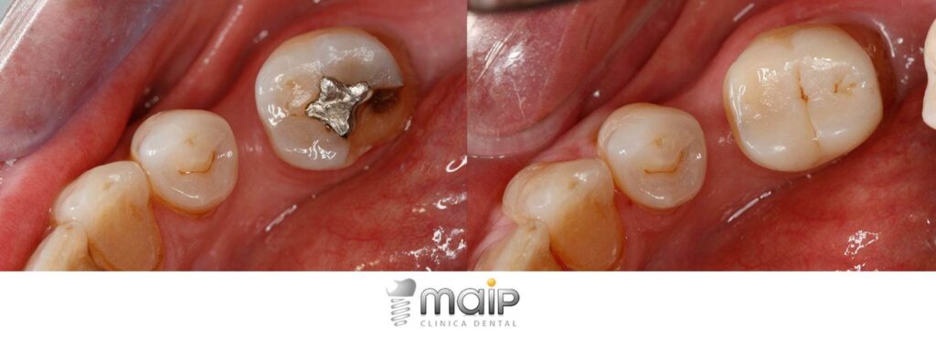 cuantas caries es normal tener