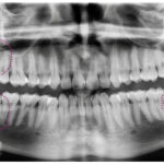 cuantas-muelas-del-juicio-son