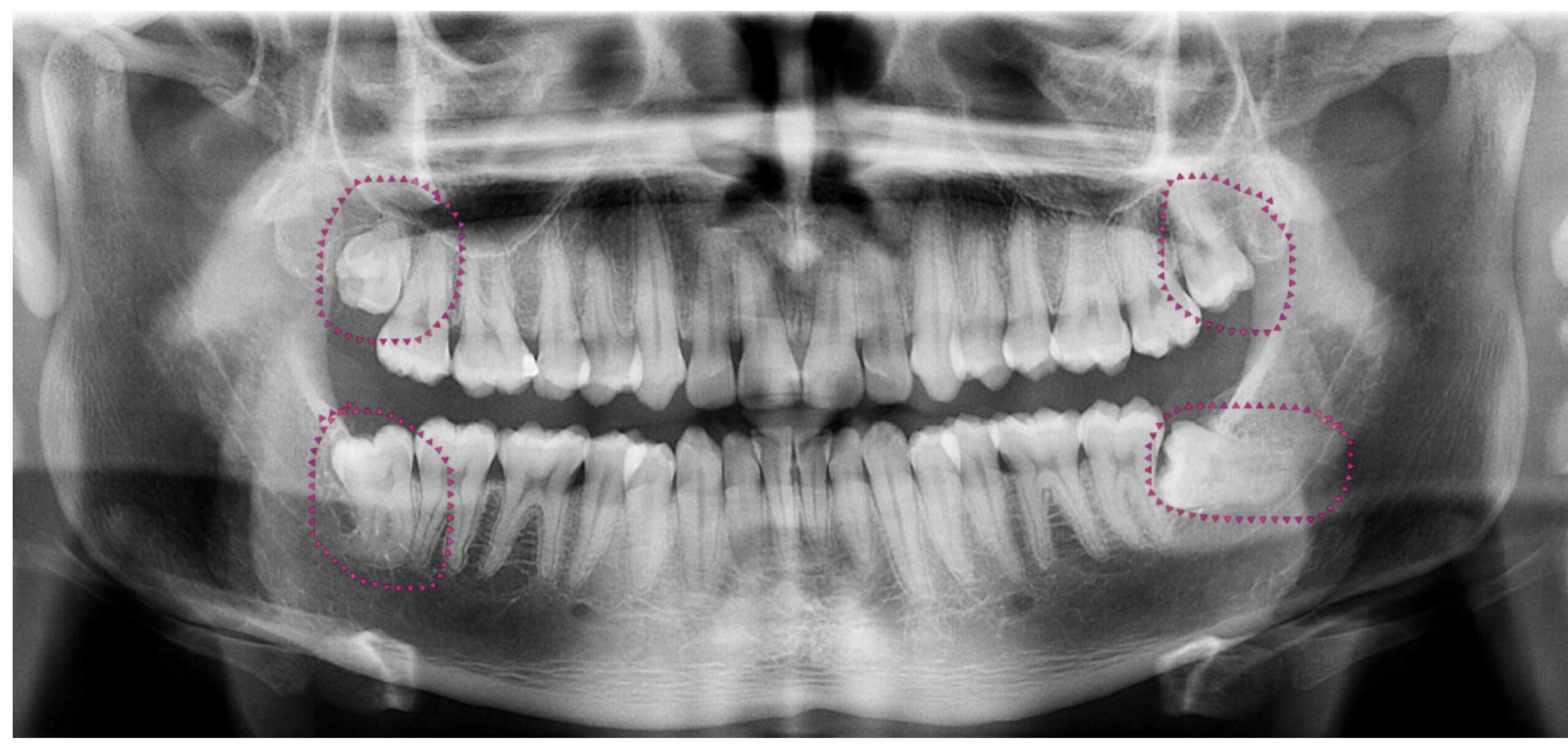 Blog 12 cuantas muelas del juicio son scaled