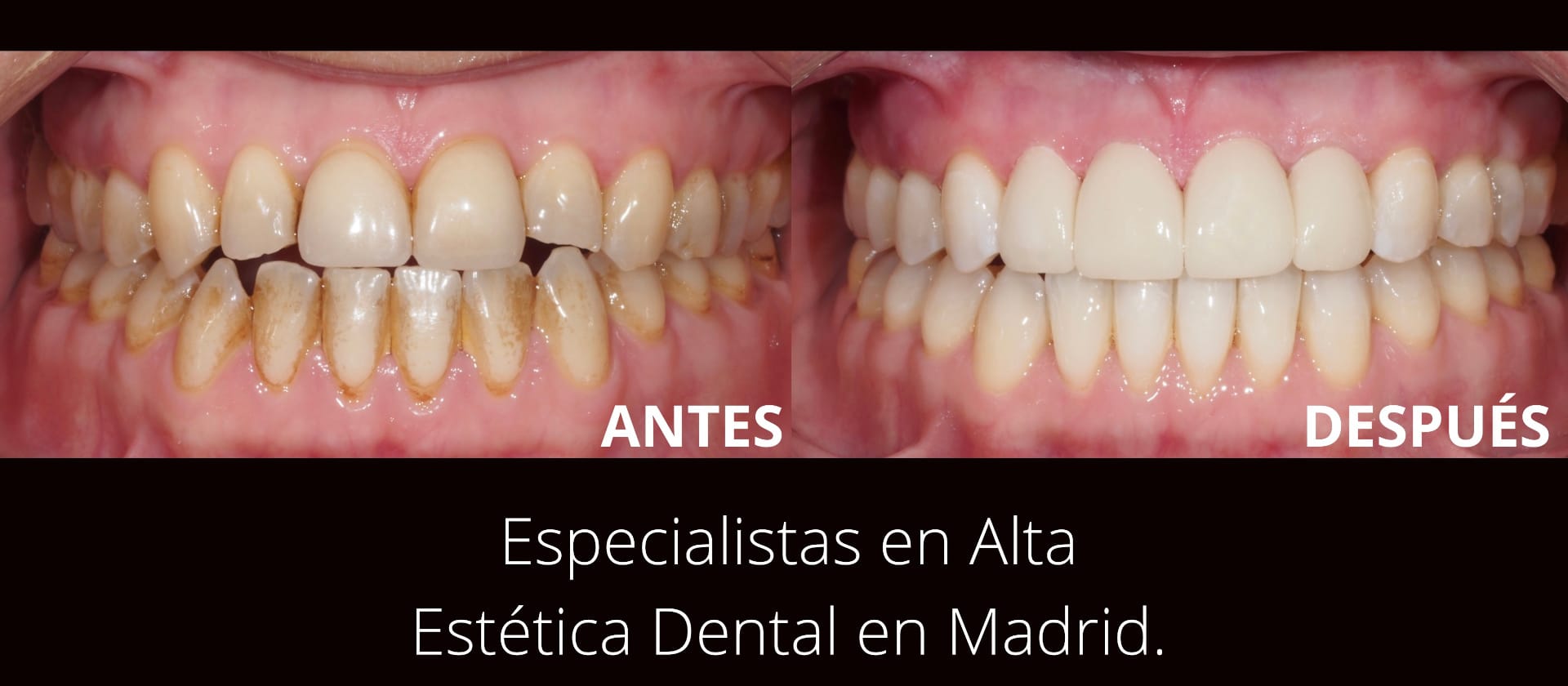 Blog 2 cuanto cuesta arreglar dientes desgastados