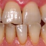cuanto-cuesta-blanquear-los-dientes
