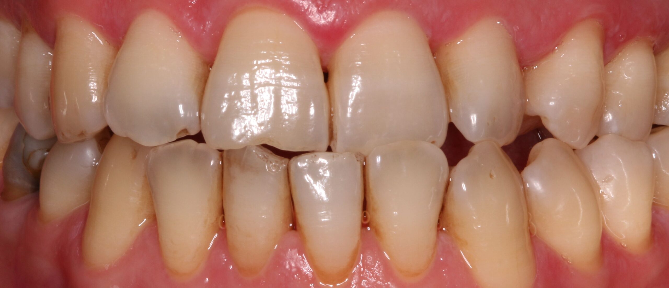 cuanto cuesta blanquear los dientes scaled