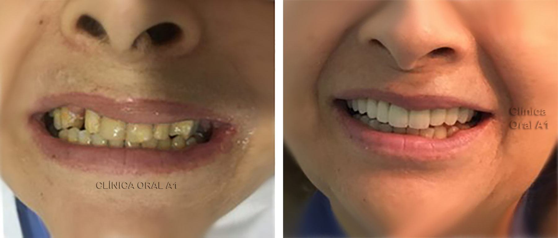 cuanto cuesta eliminar caries