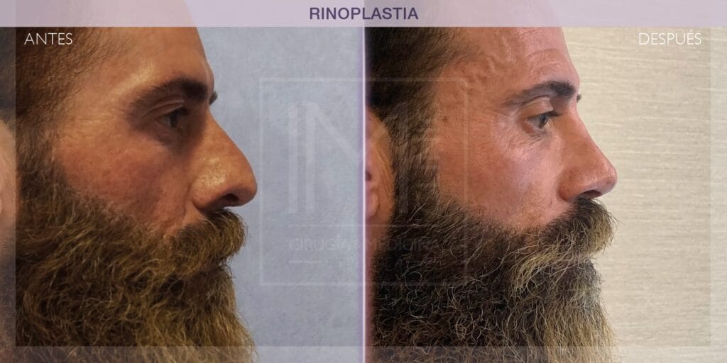 cuanto cuesta hacerse una rinoplastia