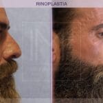 cuanto-cuesta-hacerse-una-rinoplastia