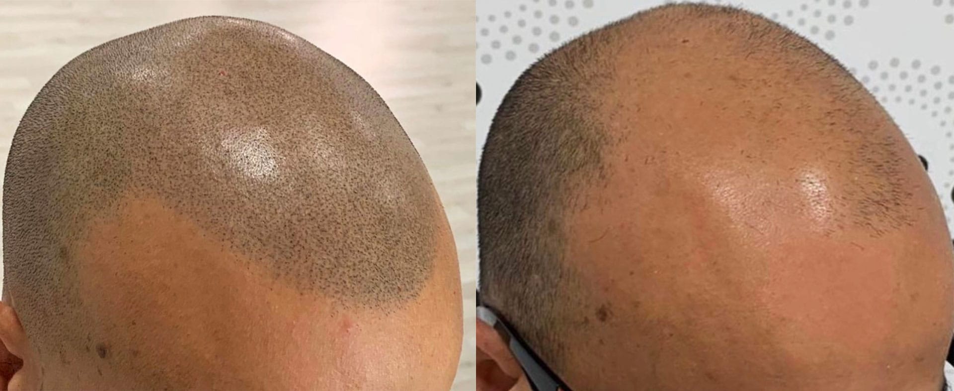 cuanto cuesta la micropigmentacion capilar