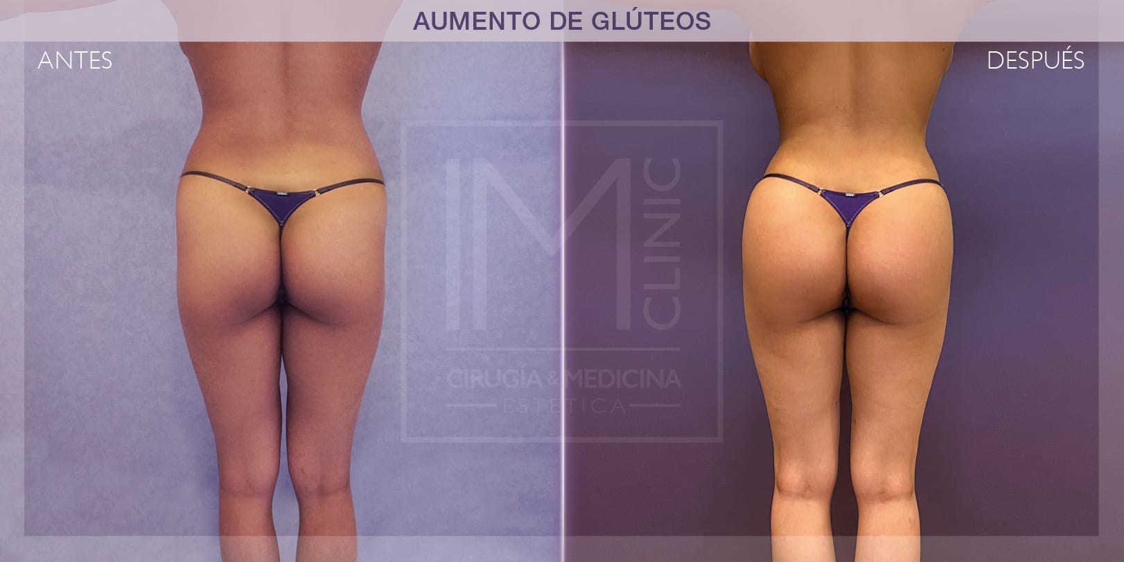 cuanto cuesta operarse los gluteos
