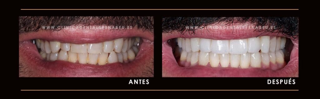 cuanto cuesta ponerse carillas dentales