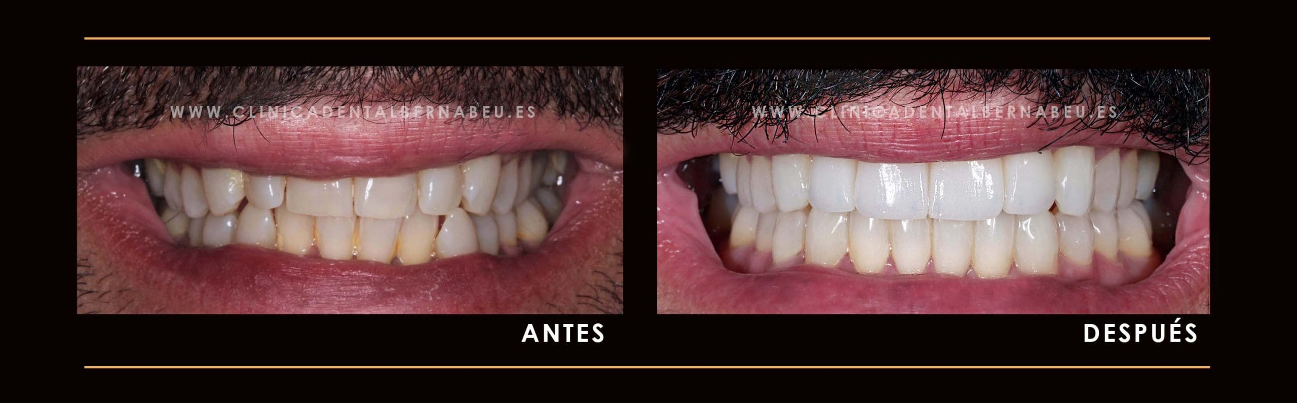 cuanto cuesta ponerse carillas dentales