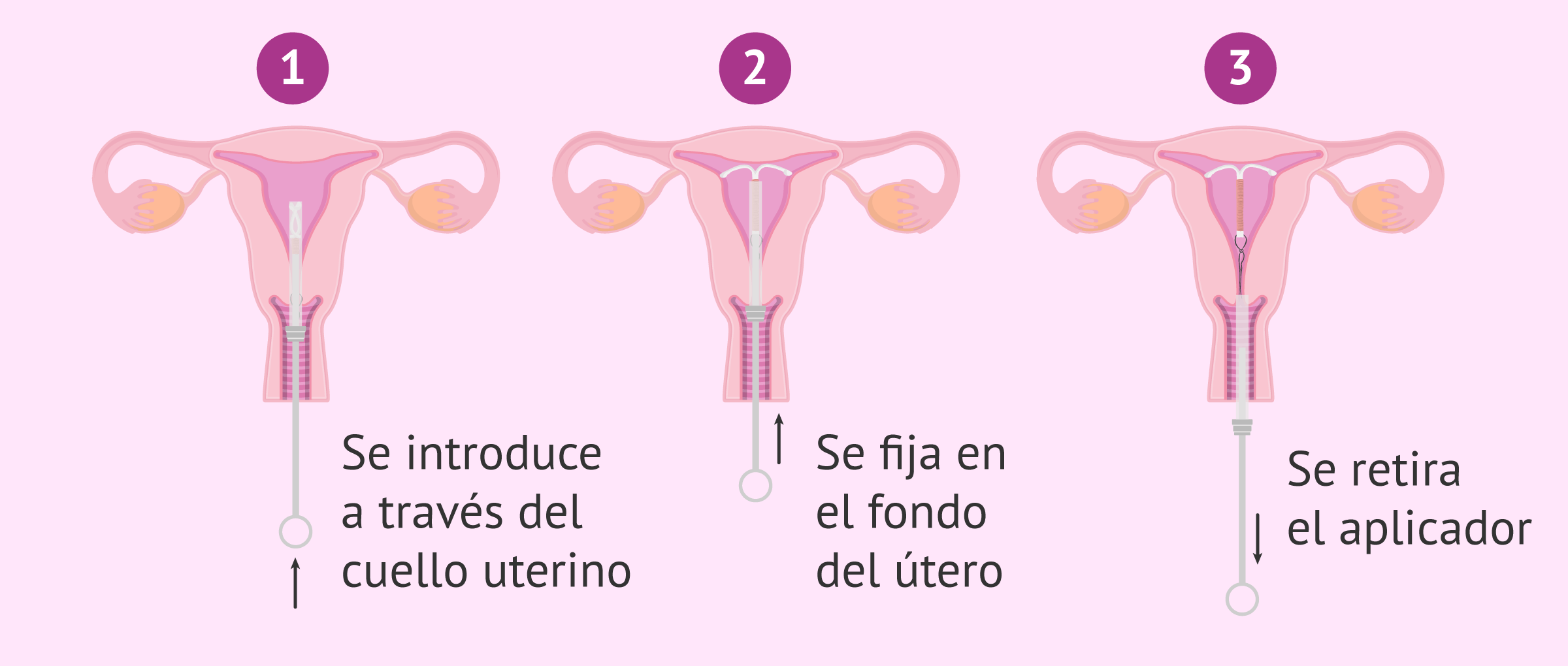 cuanto cuesta ponerse el diu