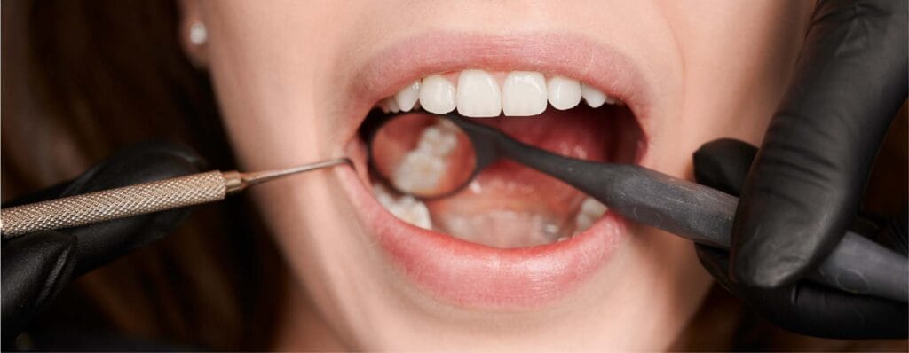 cuanto cuesta quitar una muela