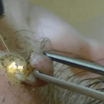 cuanto-cuesta-quitar-verrugas-genitales