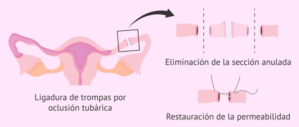 cuanto cuesta revertir la salpingoclasia
