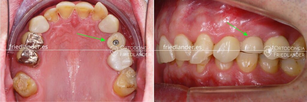 cuanto cuesta tapar una muela
