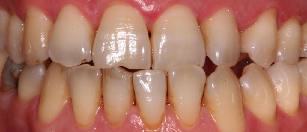 cuanto cuesta un blanqueamiento dental