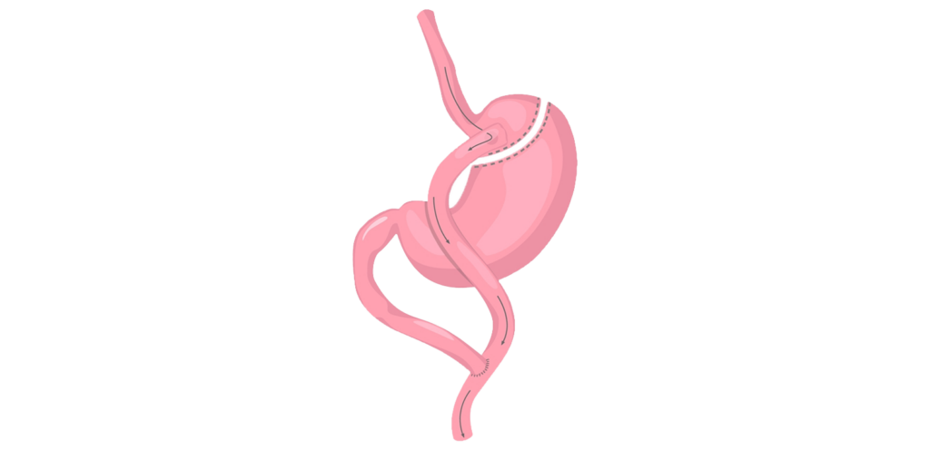 cuanto cuesta un bypass gastrico