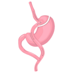 cuanto-cuesta-un-bypass-gastrico