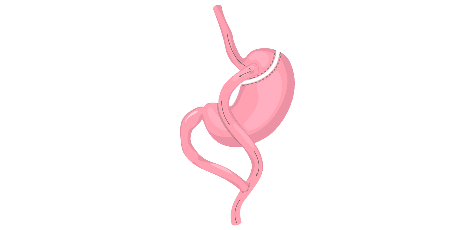 Blog 10 cuanto cuesta un bypass gastrico