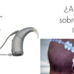 cuanto-cuesta-un-implante-coclear