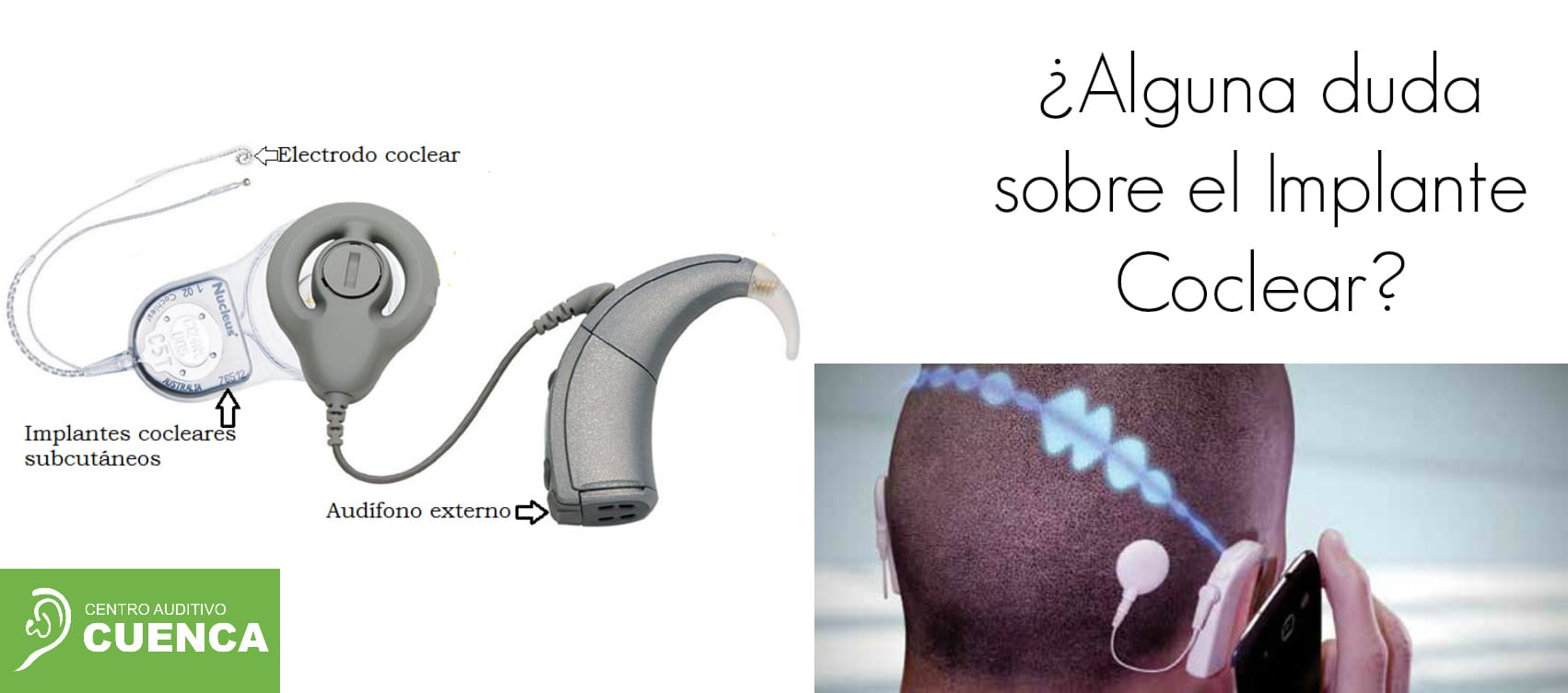 cuanto cuesta un implante coclear