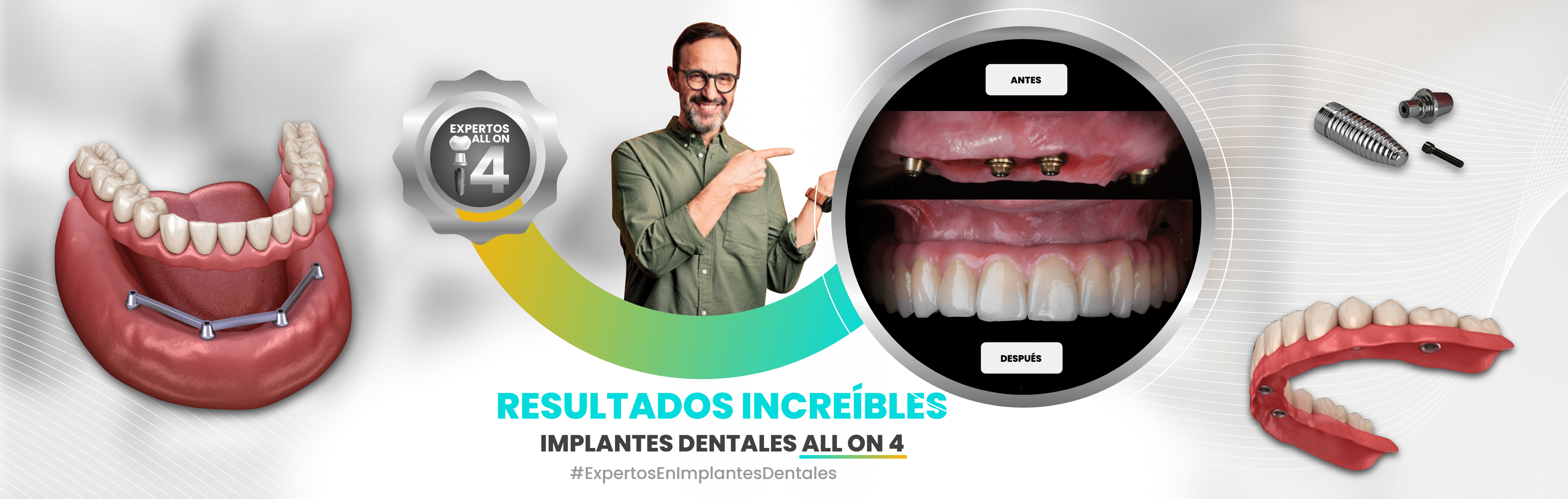 cuanto cuesta un implante dental