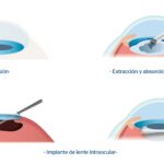 Cuánto cuesta un lente intraocular? cuanto-cuesta-un-lente-intraocular