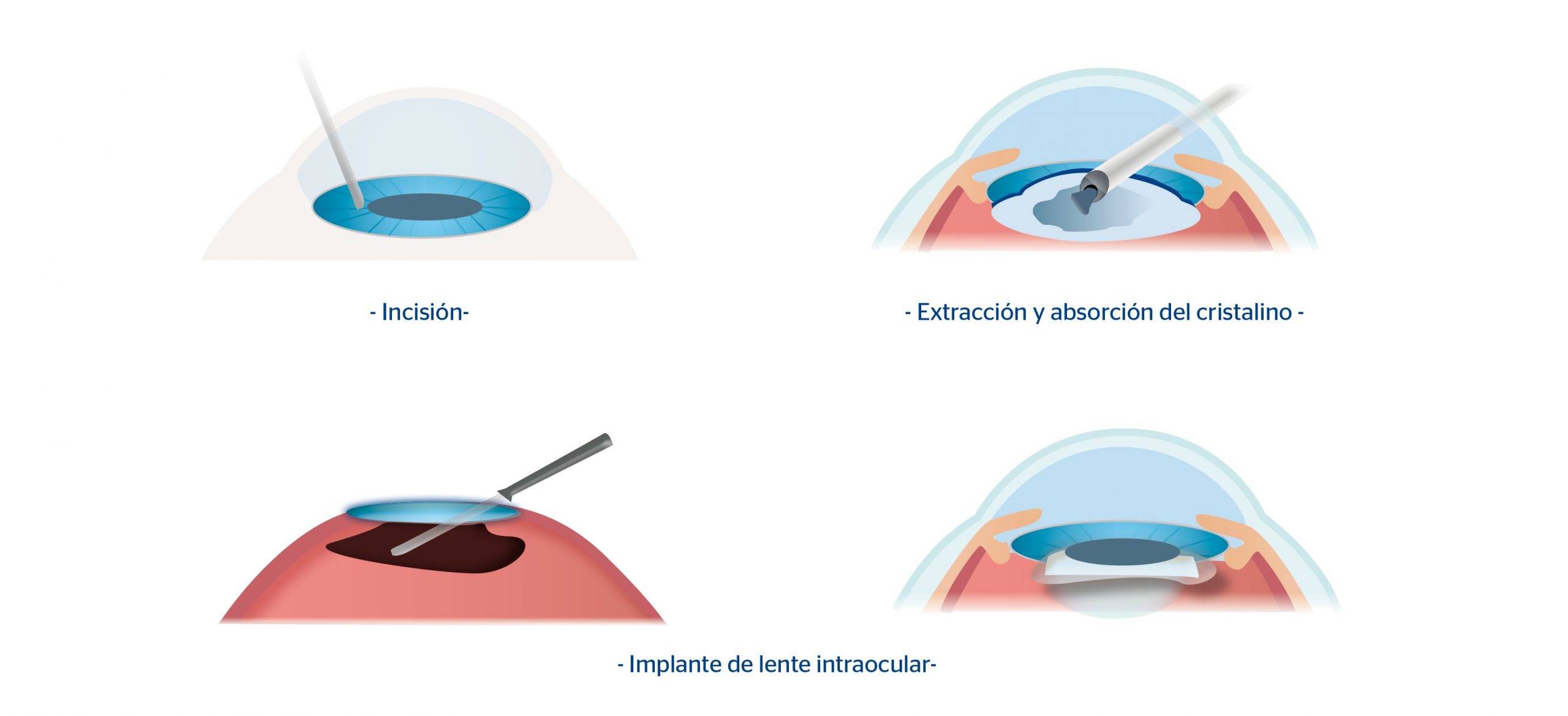 Blog 10 cuanto cuesta un lente intraocular