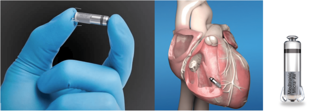 cuanto cuesta un marcapasos