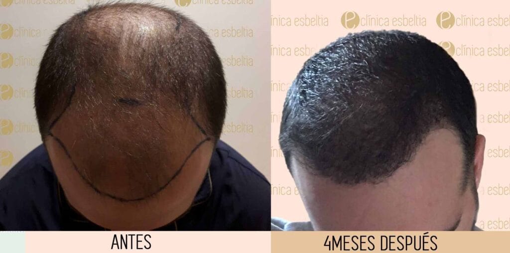 cuanto cuesta un microinjerto