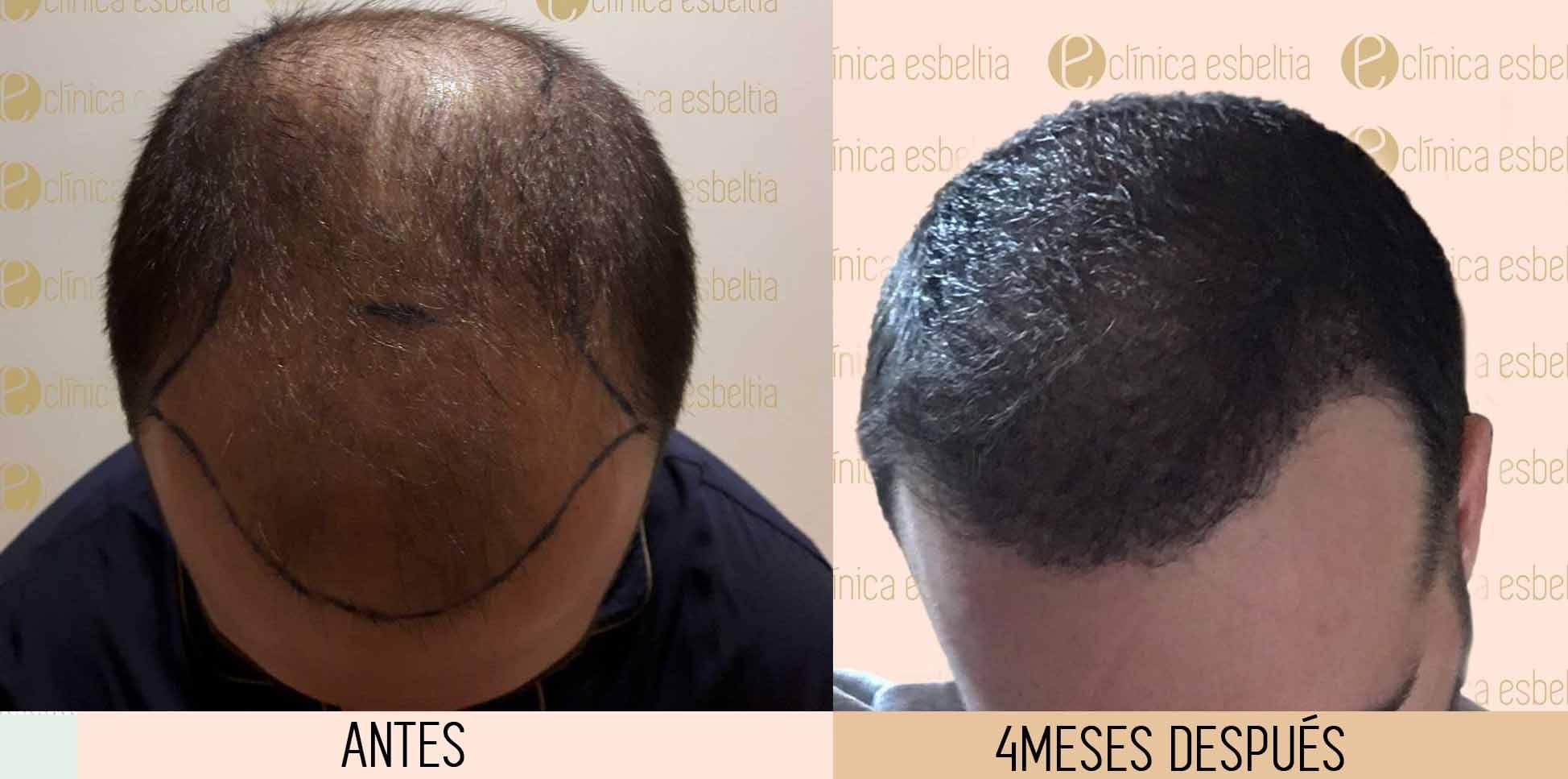 cuanto cuesta un microinjerto