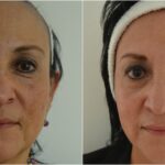 cuanto-cuesta-un-peeling