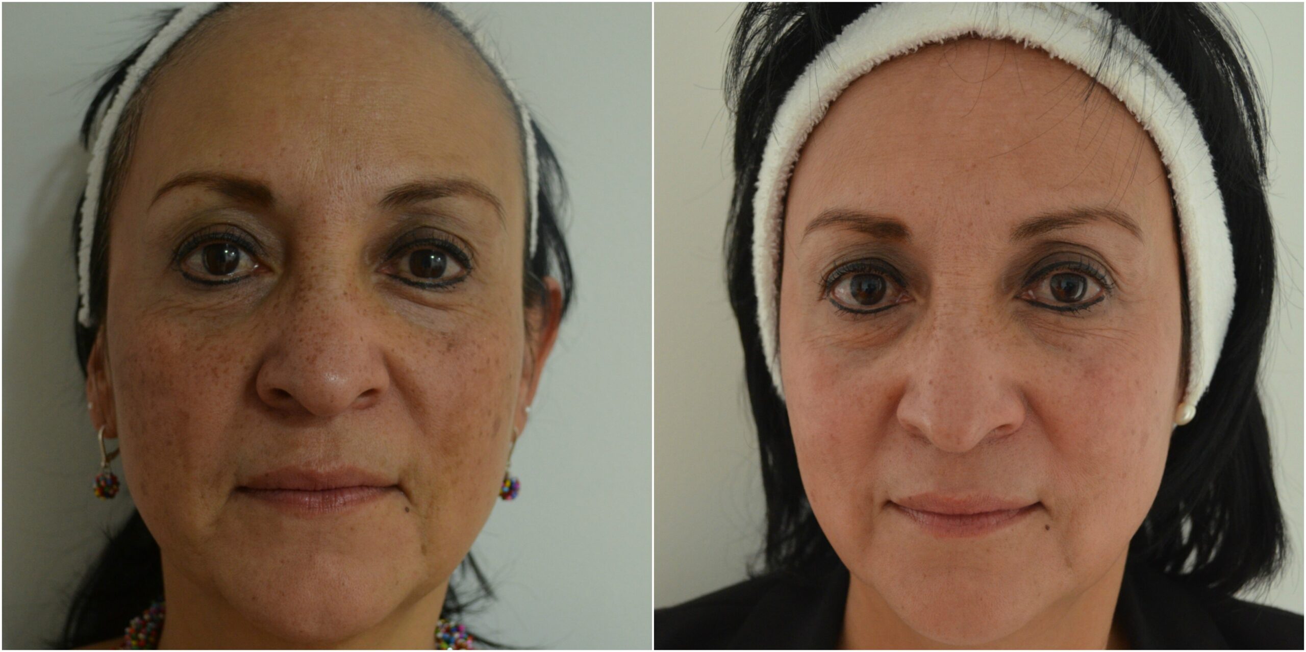 Blog 2 cuanto cuesta un peeling scaled