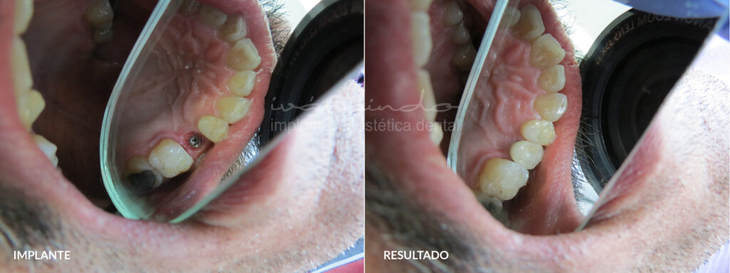 cuanto cuesta un puente dental
