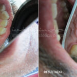 cuanto-cuesta-un-puente-dental