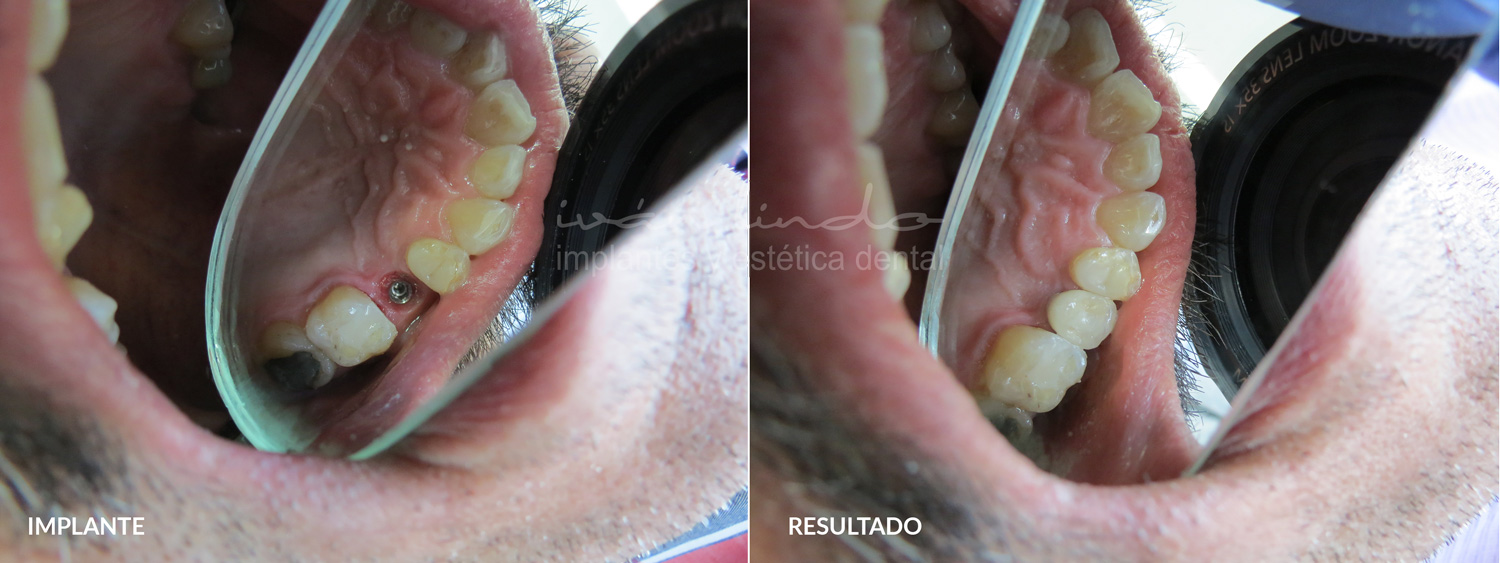 Blog 4 cuanto cuesta un puente dental
