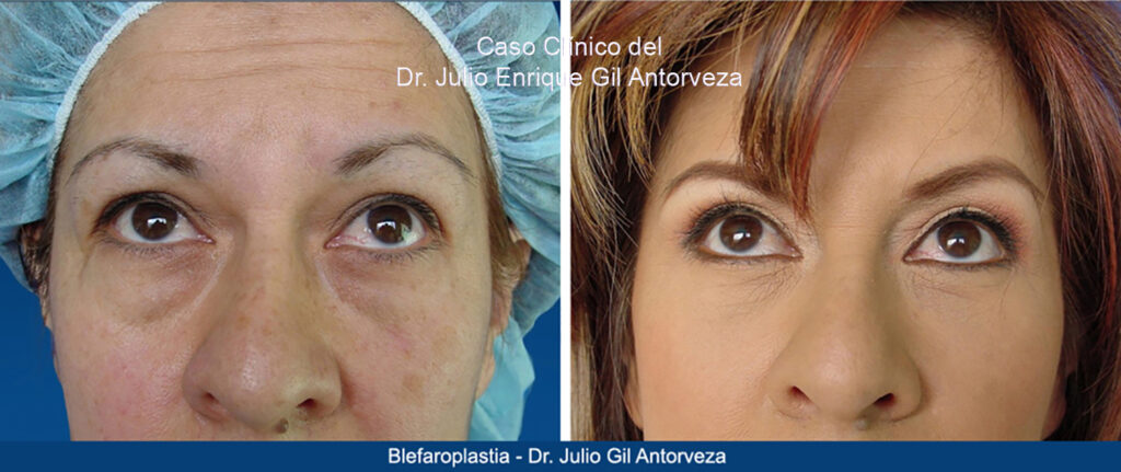 cuanto cuesta una blefaroplastia