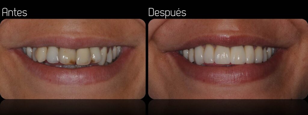 cuanto cuesta una corona dental