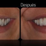 cuanto-cuesta-una-corona-dental