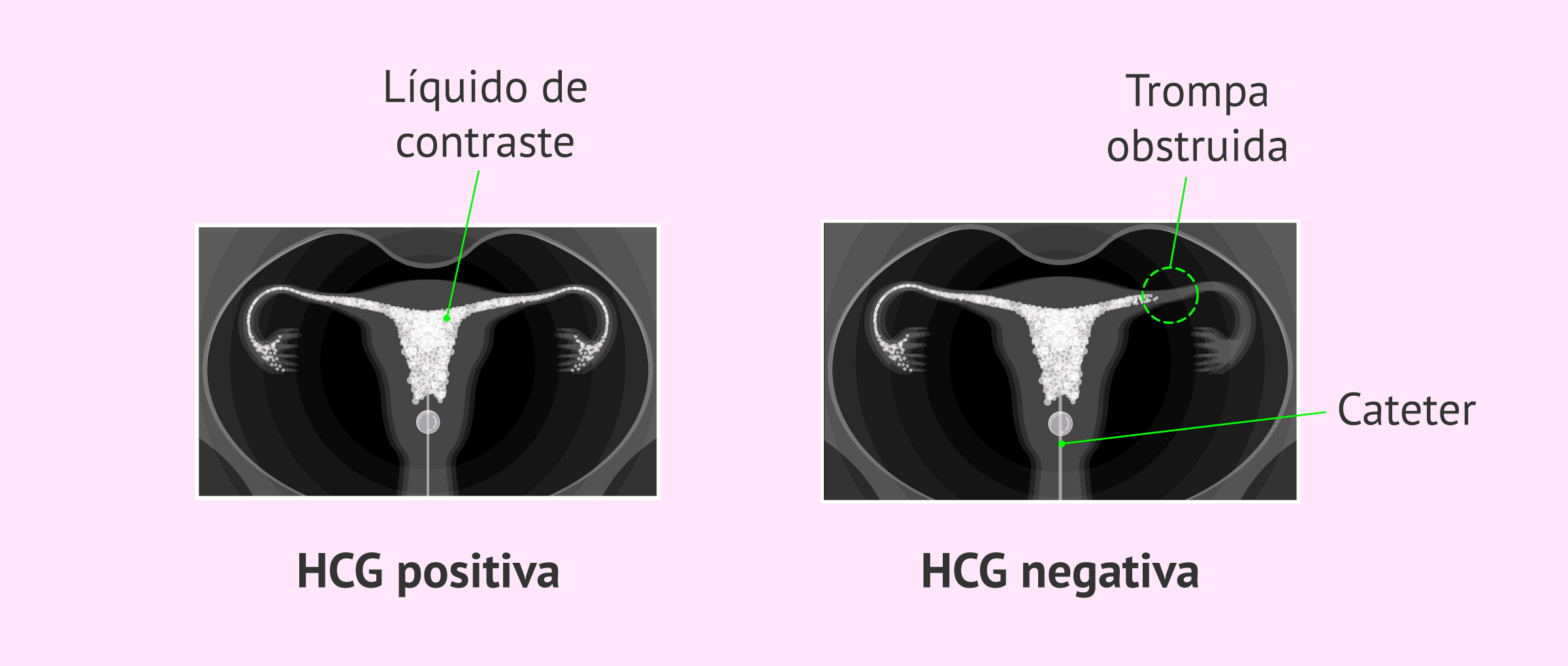 cuanto cuesta una histerosalpingografia