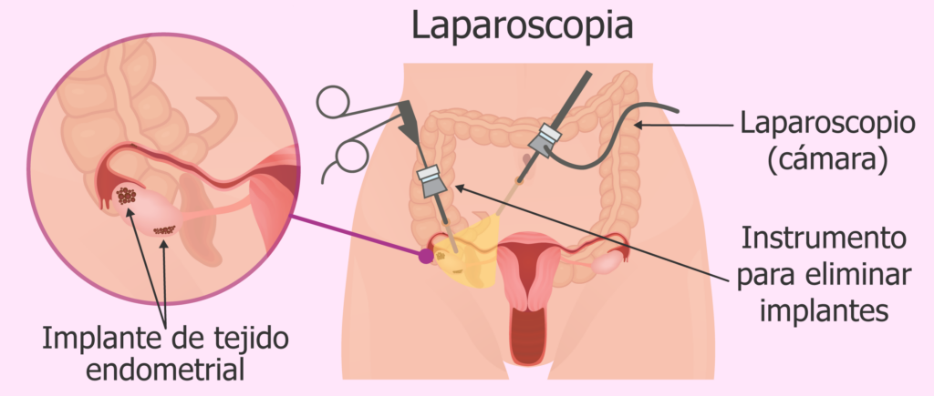 cuanto cuesta una laparoscopia