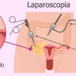 ¿Cuánto cuesta una laparoscopía? cuanto-cuesta-una-laparoscopia