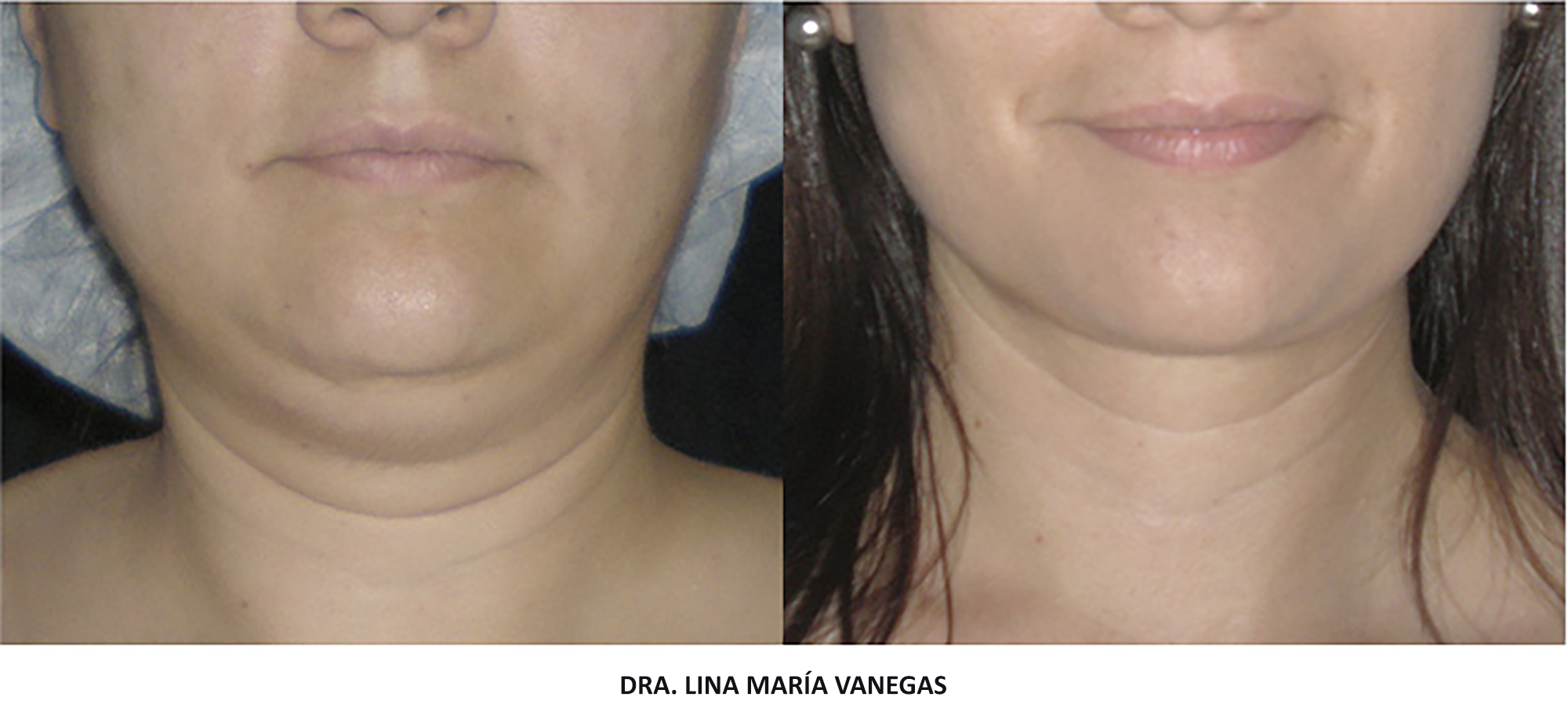 cuanto cuesta una lipopapada