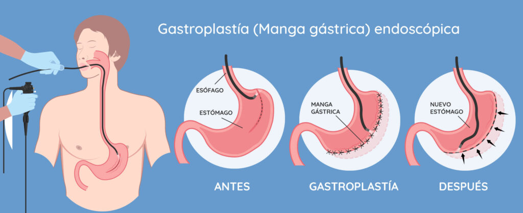 cuanto cuesta una manga gastrica