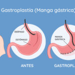 cuanto-cuesta-una-manga-gastrica