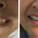 cuanto-cuesta-una-muela-postiza